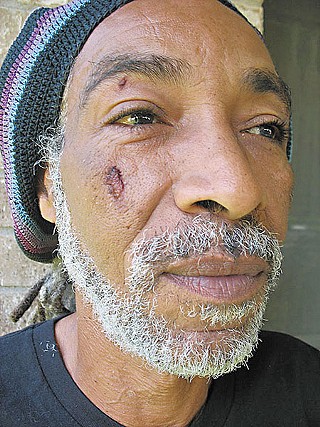 This photo, taken four days after his encounter with Houston Police, shows Harold McMillan with a deep gouge on his face. Other photos show scrapes and bruises on his torso and arms.