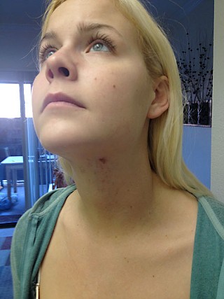 Caroline Callaway displays the injuries on her neck she says are the result of APD's blood draw.